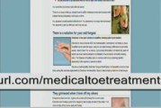 Medical Treatments for Toe Nail Fungus - Faster Results Tip