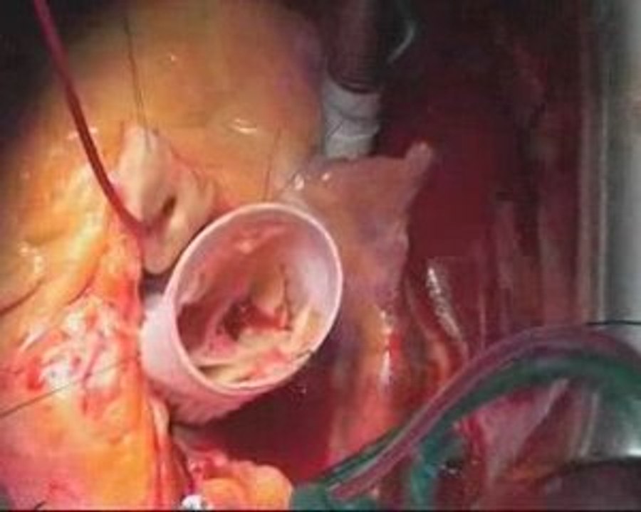 Intervention sur la racine de l'aorte