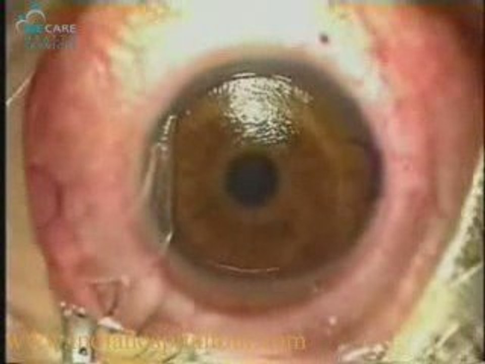 Eye Surgery,Eye Surgery India,Low Cost Eye Surgery India,Ind