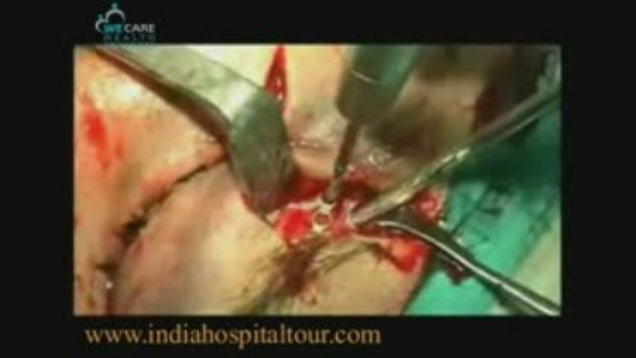 General Surgery,General Surgery India,Cost General Surgery