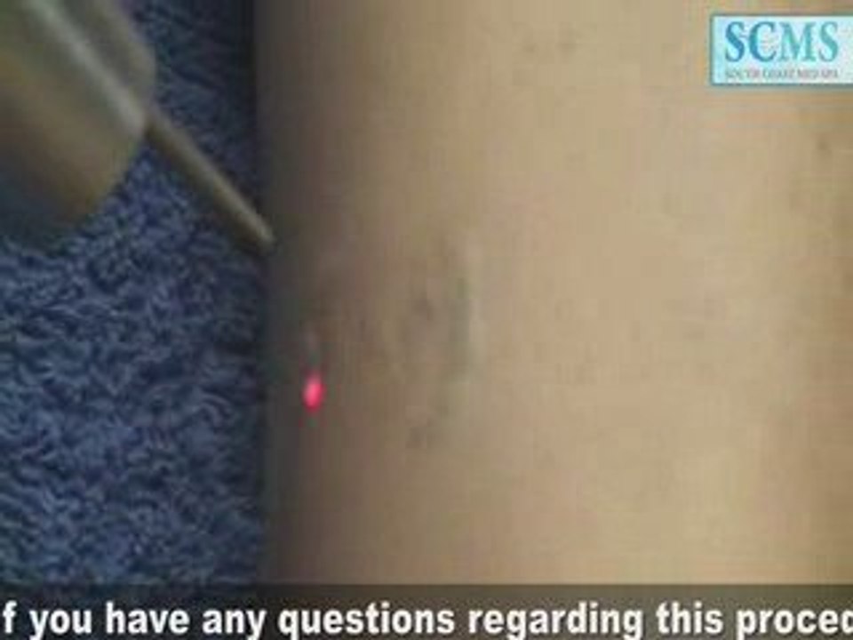 Laser Tatto Removal Leg