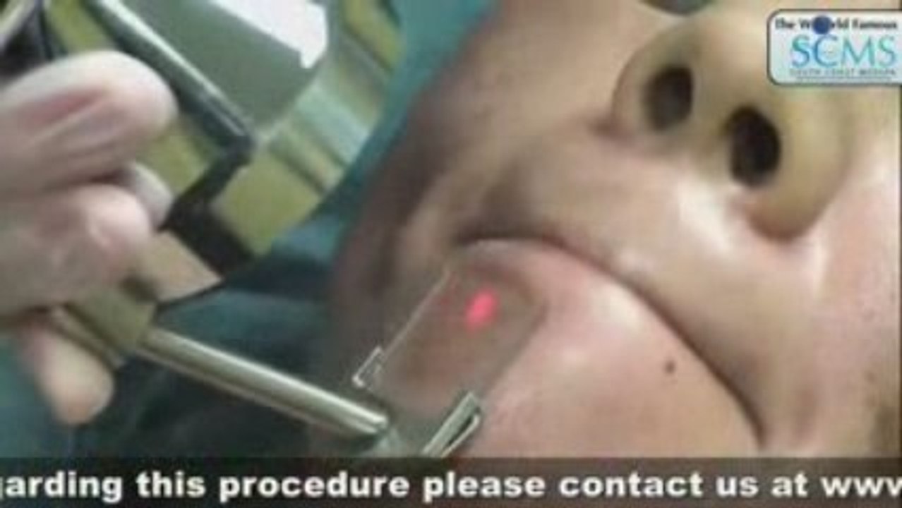 Laser Acne Removal Asian Skin Type