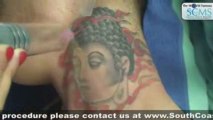 Laser Tattoo Removal Neck