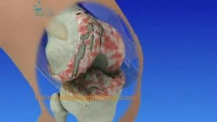 Orthopedic Surgery India,Orthopedic Surgery in India,Orthope