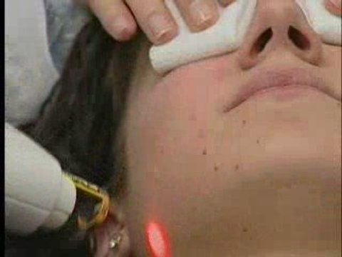 Acne Scar Removal Treatment - Dr. Goldberg in NJ