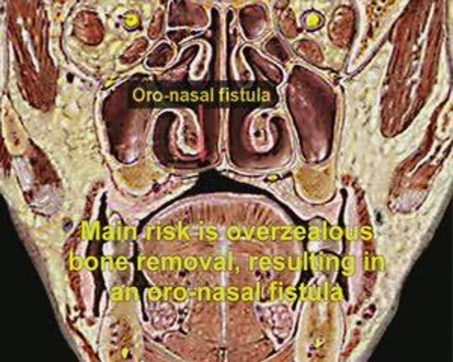 TORUS PALATINO - CIRUGIA
