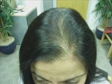 Hair Loss Treatment,Hair loss cure in usa,hairloss in usa,uk