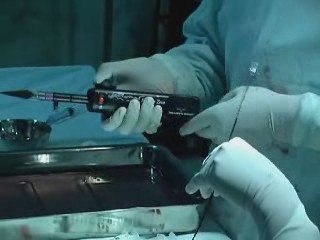 Silverhawk Atherectomy for Peripheral vascular disease