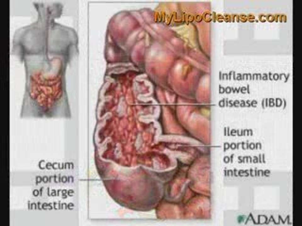 Bowtrol Colon Cleanse