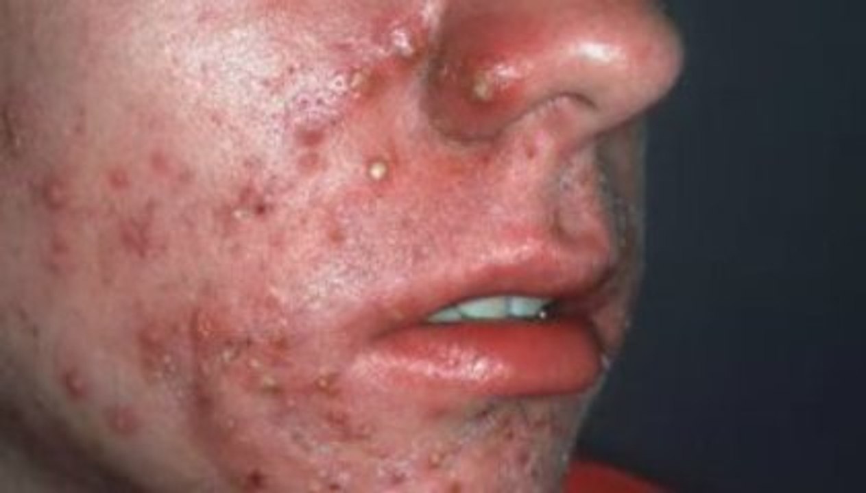 http://www.acne-naturaltreatment.com
