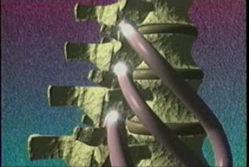 Chiropractor Dr. Wisniewski Defines ‘Vertebral Subluxation’