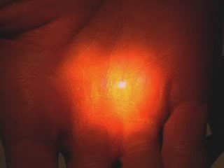 Learn LASIK Basics - Watch the LASIK Procedure