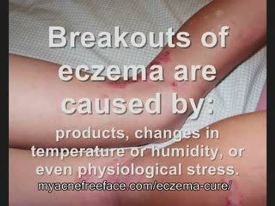 Eczema Treatment, Eczema Remedy