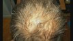 Baldness treatments ,hair loss baldness treatment in UK USA