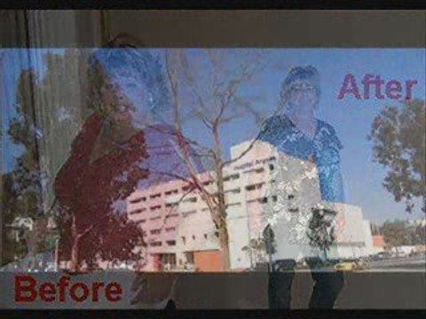 Affordable Lap Band Surgery Jacksonville Fl