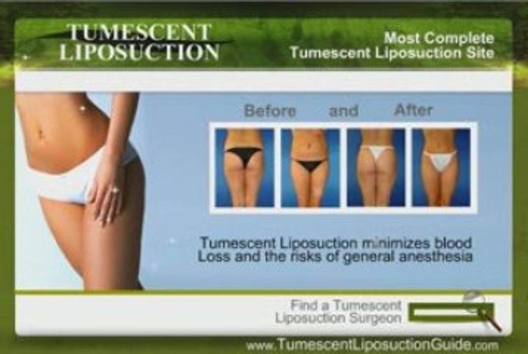 Tumescent Liposuction # 5