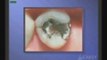 Dental fillings / cosmetic dentistry / Glendale / Dr. Sahabi