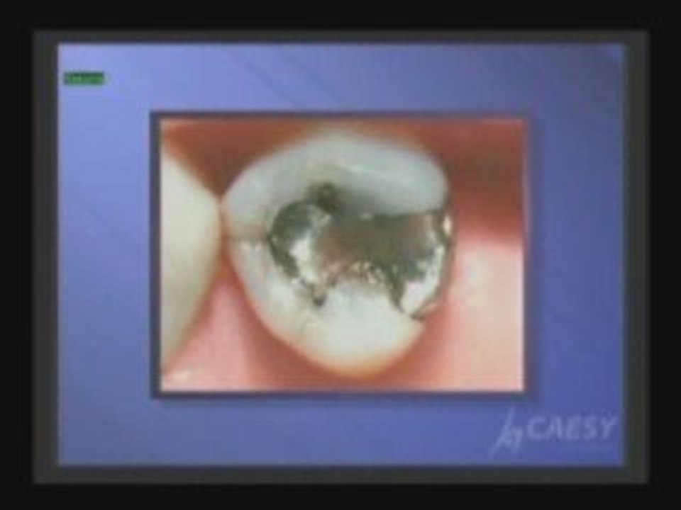 Dental fillings | cosmetic dentistry |Glendale | Dr. Sahabi