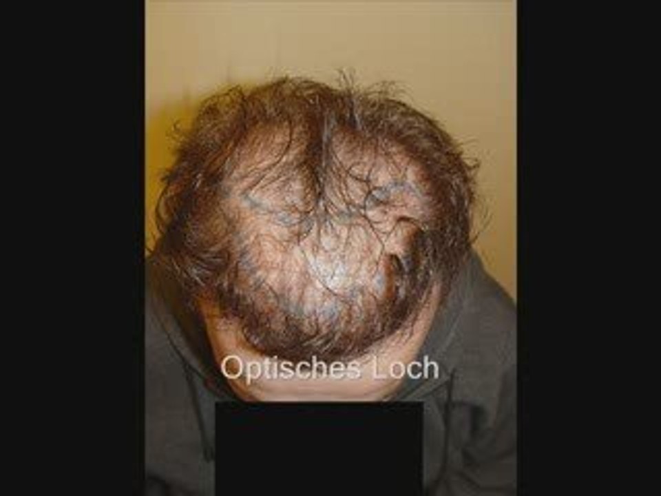 Haartransplantation resultat video 2400 grafts