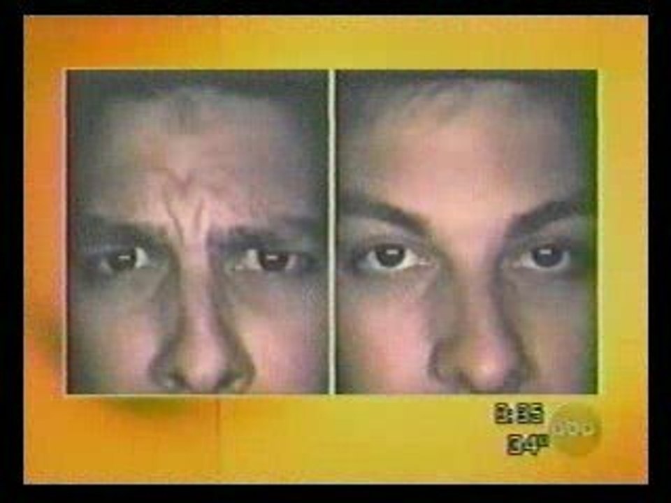 Baby boomers getting Botox
