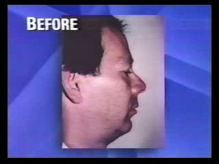 Jaw Reconstruction surgery in NYC