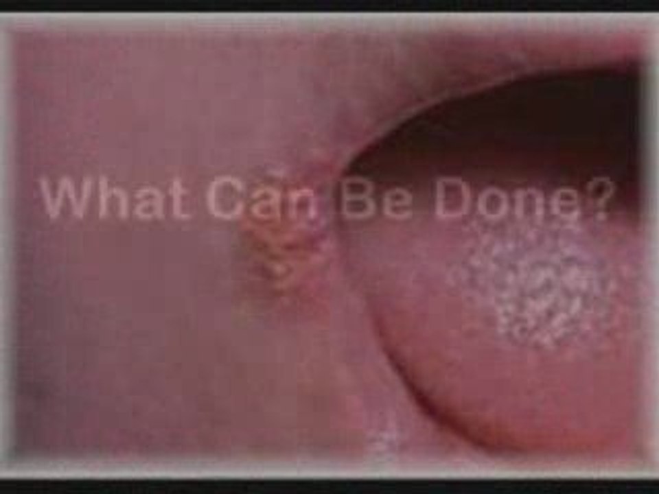 Angular Cheilitis Natural Remedies - Cures for Perleche