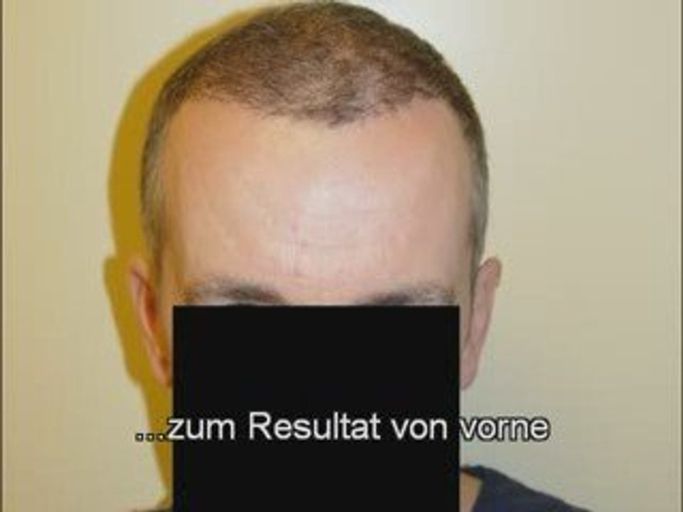Haartransplantation resultat doktor heitmann 2000 grafts