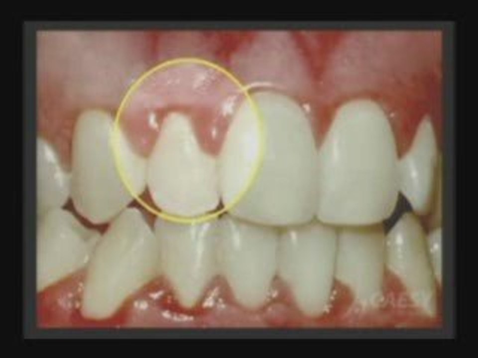 Periodontal disease | Gum disease | Dr. Sahabi | Burbank