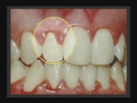 Periodontal disease | Gum disease | Dr. Sahabi | Burbank