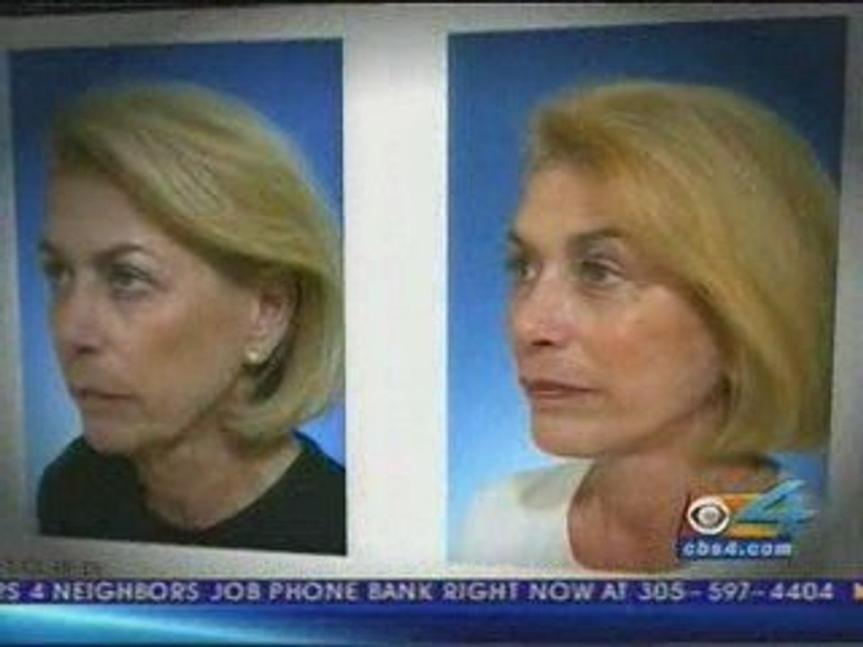 Deep Plane Facelift