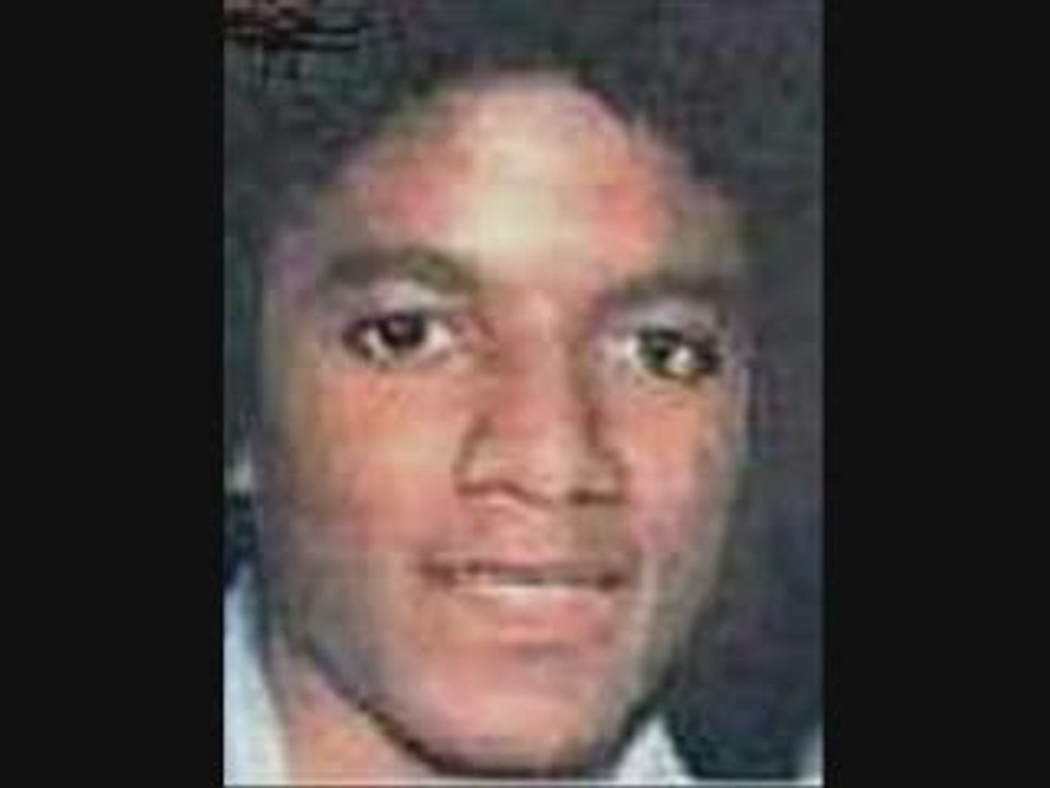 vitiligo Micheal Jackson