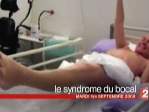syndrome guillain-barré le syndrome du bocal D.Pujadas