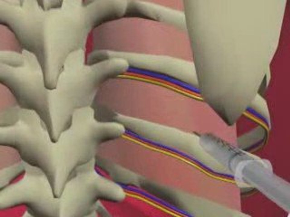 Thoracentesis - General Procedures