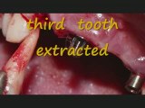 ludhiana dental implants dentist punajb india jalandhar
