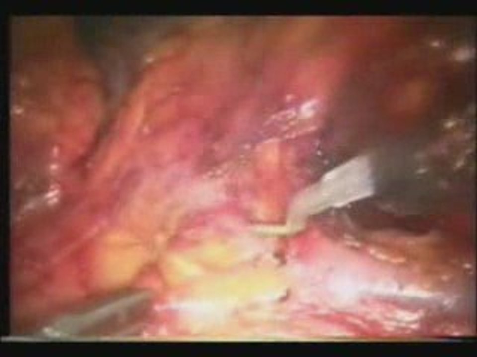 Kidney Transplantation