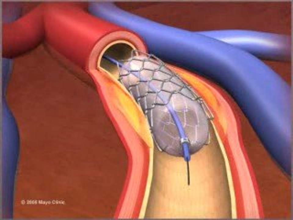 Angioplasty Ballon Heart
