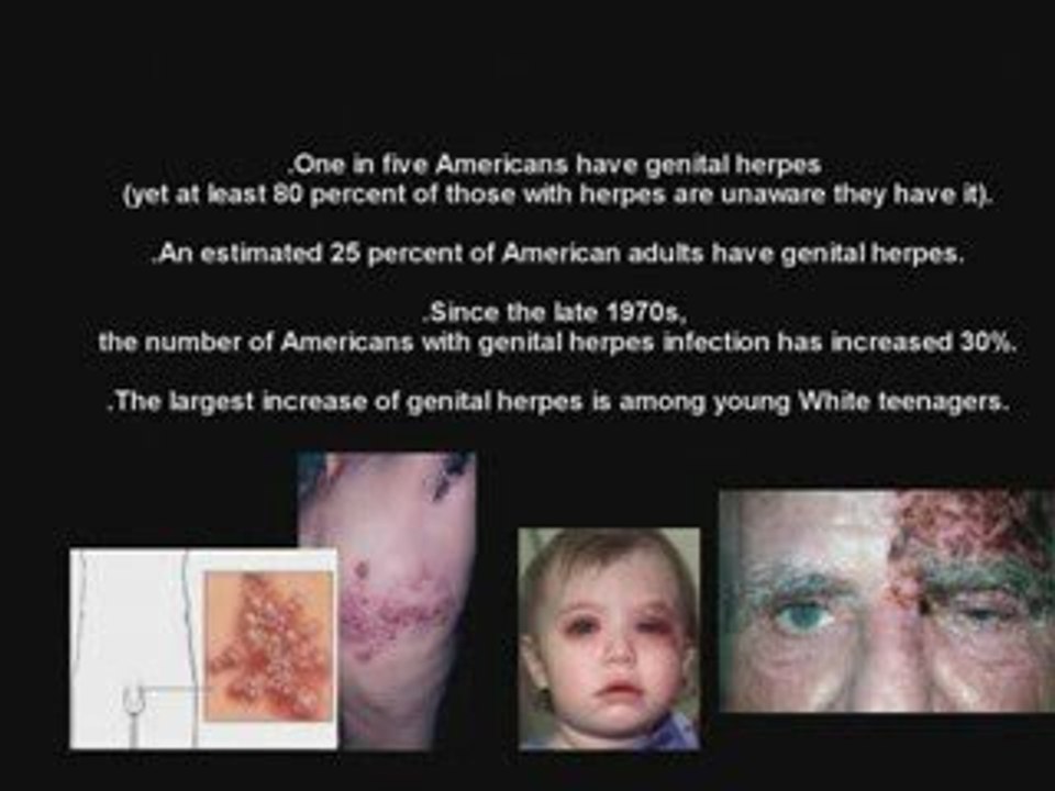 How Genital Herpes Will Affect Your Pregnancy