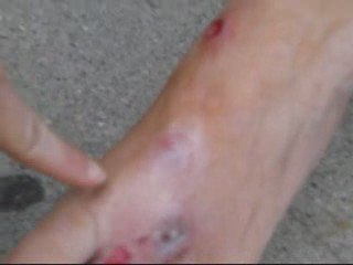 OOZING, INFECTED & JUST PLAIN NASTY FLESH WOUNDS