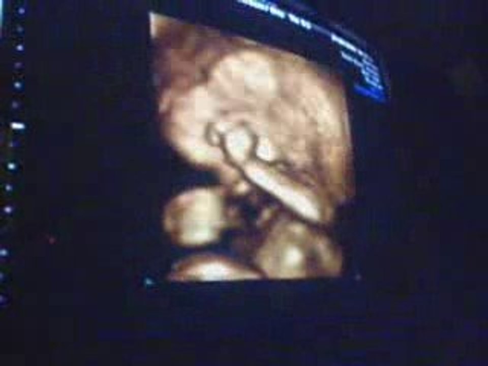 echographie de notre petit garçon