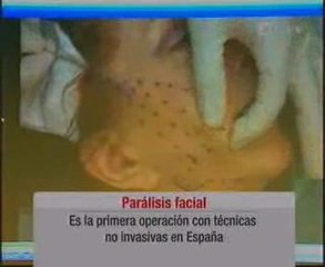 CUATRO-Javier de Benito, Paralisis facial, Silhouette-lift.