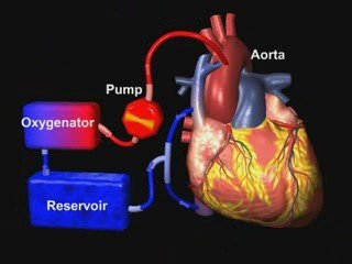Coronary Bypass Surgery