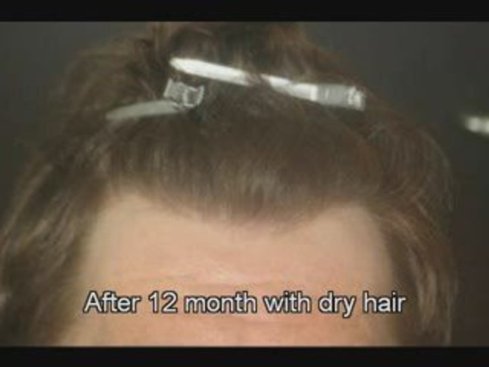 Haartransplantation Video Dr Mwamba