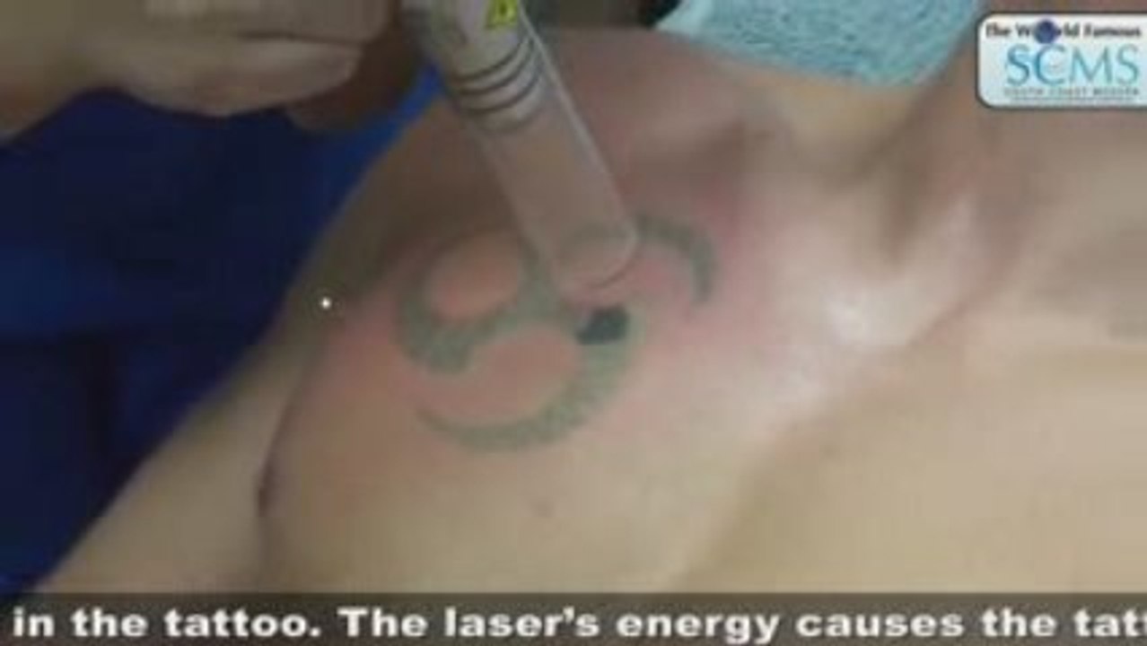 Laser Tattoo Removal