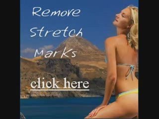 Best Way to Reduce Stretch Marks