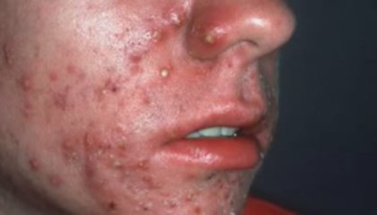 Acne natural treatment