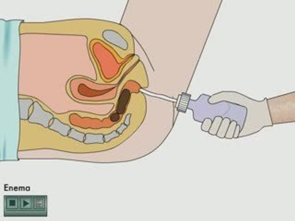  Enema 