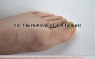 Toenail Fungus Removal is Harder Because of New Strands - Fi