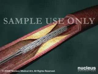 Balloon Angioplasty with Stent Repair (Detail)