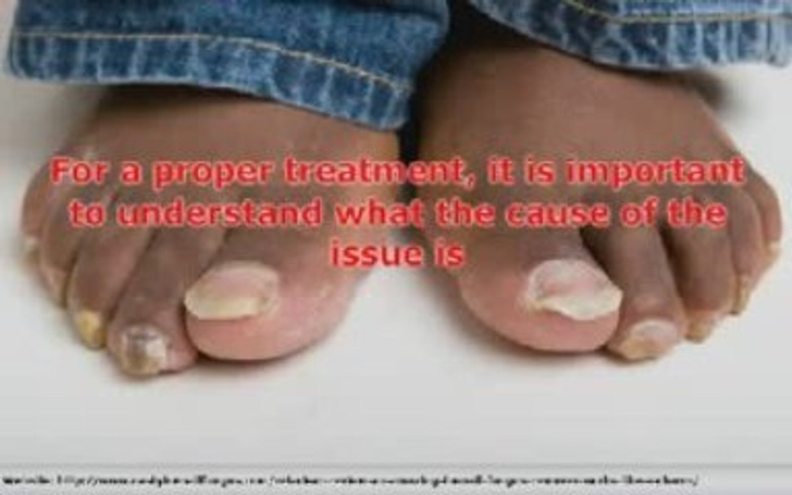 Is your finger nail fungus scaring people away? Try these am