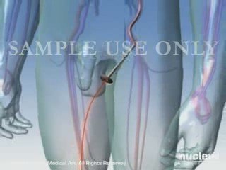 Coronary Artery Angiography Procedure